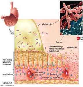 Helicobacter pylori infection of the stomach lining