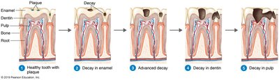 Progression of dental caries from healthy tooth to decay in pulp