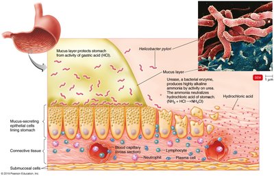 Pathogenesis of Helicobacter pylori in the stomach lining