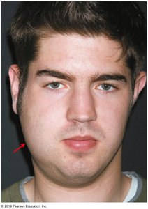 Swelling of parotid gland in mumps