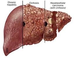 Liver with chronic hepatitis, cirrhosis, and carcinoma