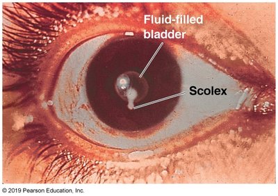 Tapeworm cyst in the eye (ophthalmic cysticercosis)