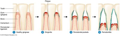 Progression from healthy gingivae to periodontitis