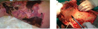 Necrotizing fasciitis: clinical presentation and surgery