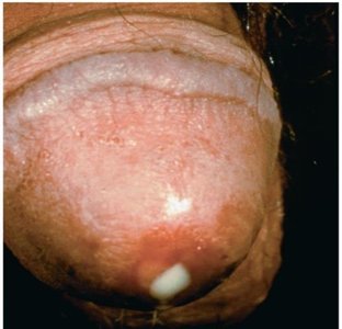 Urethral discharge in male with gonorrhea