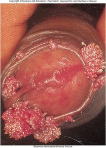 Genital warts on male genitalia