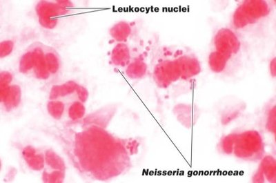 Microscopic view of Neisseria gonorrhoeae and leukocytes