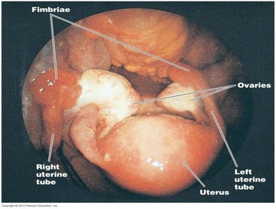Pelvic inflammatory disease affecting female reproductive organs