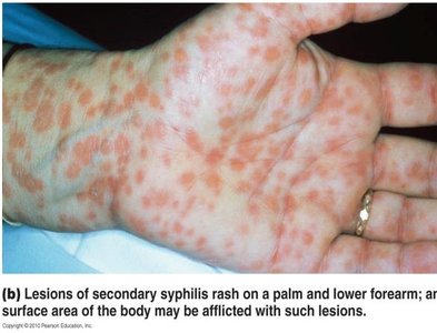 Secondary syphilis rash on hand