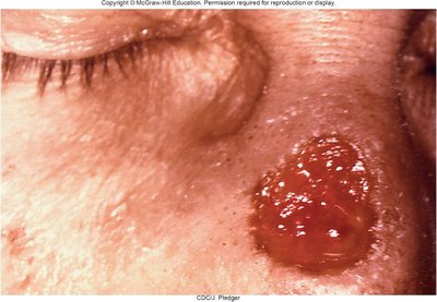 Gummatous lesion of tertiary syphilis