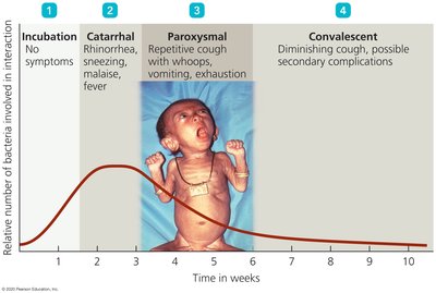 Time course for progression of pertussis