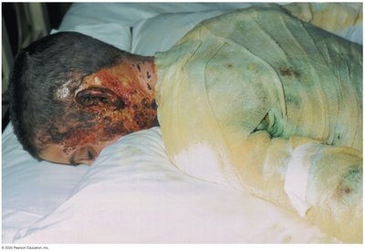 Pseudomonas aeruginosa infection in burn patient