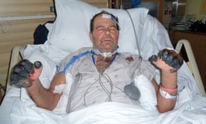 Patient with severe complications from plague (sporadic example)