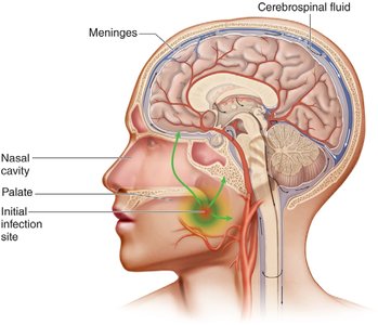 Meningococcal infection in the brain