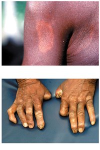 Tuberculoid and lepromatous leprosy lesions