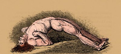 Tetanus-induced muscle spasms (opisthotonos)