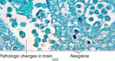 Naegleria fowleri in brain tissue
