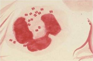 Gram-negative diplococci of Neisseria