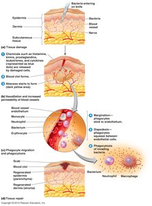 Diagram of the stages of inflammation