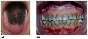 Examples of antimicrobial side effects: black hairy tongue and teeth discoloration