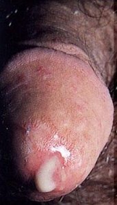 Pus-containing discharge from urethra in gonorrhea