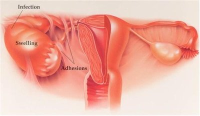 Pelvic inflammatory disease showing infection, swelling, and adhesions