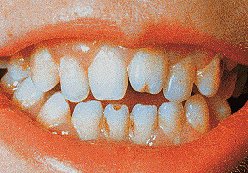 Hutchinson's teeth in congenital syphilis