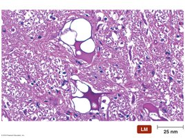 Spongy appearance of brain tissue in prion disease