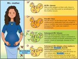 Diagram explaining Rh incompatibility and the use of RhoGAM to prevent hemolytic disease of the newborn