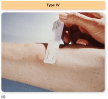 Tuberculin skin test for delayed-type hypersensitivity