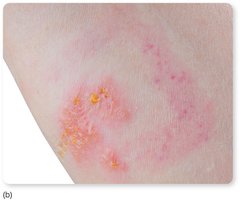Contact dermatitis lesion on the skin