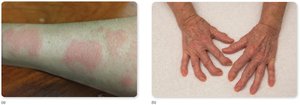 Examples of autoimmune diseases: lupus and rheumatoid arthritis