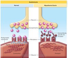 Diagram of normal neuromuscular junction and myasthenia gravis with blocked acetylcholine receptors