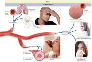 Effects of allergic mediators on tissues: bronchoconstriction, vasodilation, increased secretions, and symptoms such as headache, hives, asthma