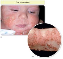 Images of atopic dermatitis (eczema) in infants and adults