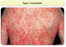 Widespread skin rash due to immediate hypersensitivity (drug allergy)