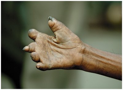 Severe deformities in lepromatous leprosy