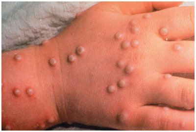 Smallpox lesions on the hand
