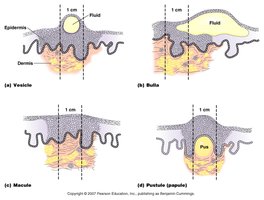 Diagram of vesicle, bulla, macule, and pustule