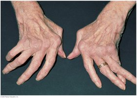 Crippling distortion of joints in rheumatoid arthritis