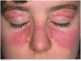 Facial rash in systemic lupus erythematosus