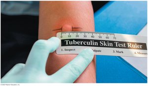 Positive tuberculin skin test