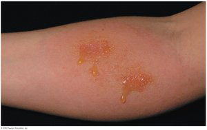 Allergic contact dermatitis with fluid-filled blisters