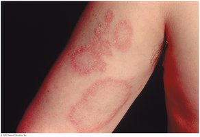 Urticaria (hives) on the skin