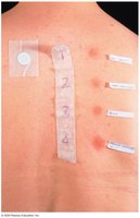 Skin test for diagnosing Type I hypersensitivity