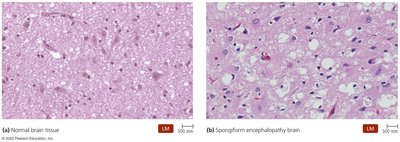 Normal vs. spongiform encephalopathy brain tissue