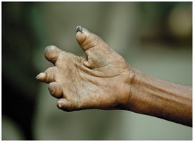 Hand deformity in lepromatous leprosy