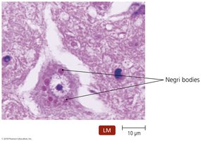 Negri bodies in rabies-infected brain tissue