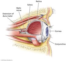 Trachoma: scarring of conjunctiva