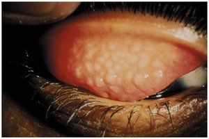 Trachoma: close-up of eyelid with follicles